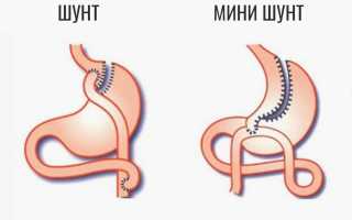 Шунтирование Желудка – Эффективное Лечение Ожирения
