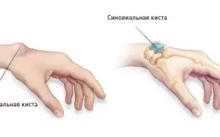 Киста на руке: как она выглядит