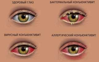 Аллергический конъюнктивит у детей