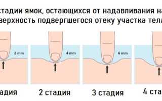 Отеки ног после кесарева сечения