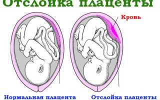 Причины отека плаценты при беременности