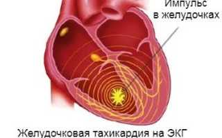 Желудочковая тахикардия, причины, лечение