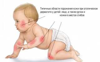 Атопический дерматит у детей. Причины, лечение, симптомы