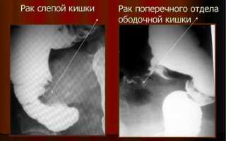Первые симптомы рака слепой кишки и особенности диагностики