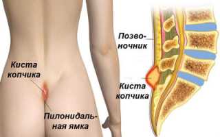 Причины и лечение копчиковой кисты