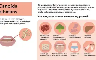 Симптомы и лечение молочницы: избавляемся от кандидоза