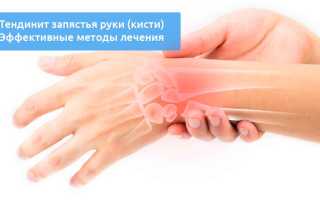 Перитендинит запястья и кисти. Симптомы, причины и лечение