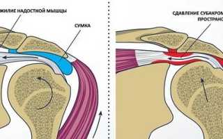 Импинджмент-синдрома плечевого сустава