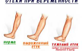 Отеки при беременности на последних неделях