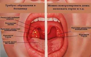 Лечение Ангины Народными Средствами