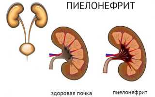 Методика терапии Цефтриаксоном при пиелонефрите