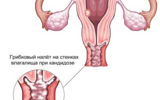 Молочница
