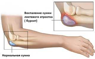 Лечение ушиба локтя