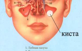 Лечение кисты гайморовой пазухи