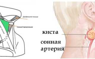 Лечение боковой кисты шеи