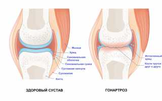 Что такое гонартроз коленных суставов?
