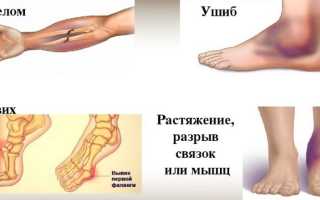 Как лечить ушибы
