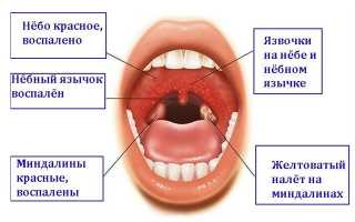 Причины и лечение герпетической ангины у детей