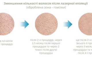 10 питань щодо лазерної епіляції