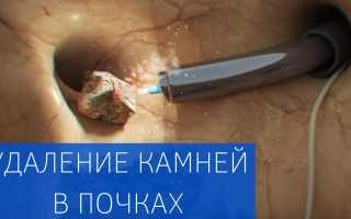 Как очистить почки и вывести камни?