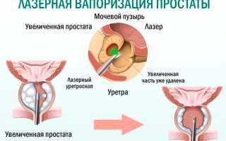 Лечение аденомы простаты: выбираем самый эффективный метод