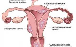 Миома матки в менопаузе – лечебная тактика