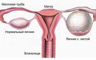 Цистаденома яичника — причины, симптомы, лечение