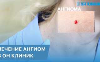 Ангиома — Лечение и Признаки Заболевания