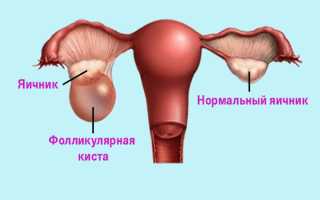 Эффективное лечение фолликулярной кисты