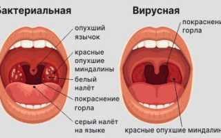 Симптомы вирусной ангины у детей и методика лечения