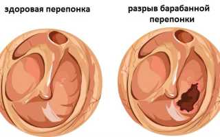 Повреждение барабанной перепонки – симптомы, диагностика и методы лечения