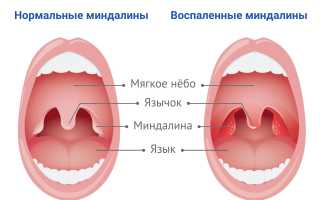 Из-за чего болят гланды? Причины, лечение
