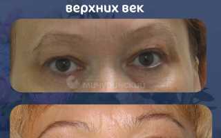 Блефаропластика: ваш новый взгляд на мир