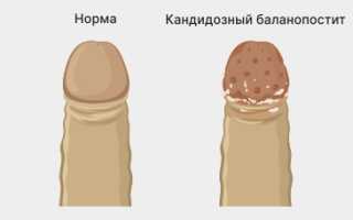 Баланопостит у мальчиков