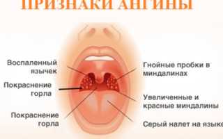 Как вылечить ангину без антибиотиков у ребенка﻿
