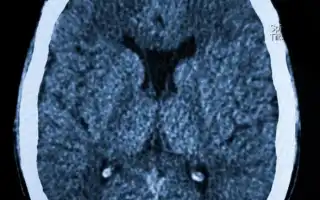 Симптомы и лечение кисты прозрачной перегородки головного мозга