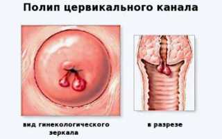 Полип цервикального канала — причины, лечение, удаление