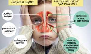 Симптомы и лечение гайморита у детей по Комаровскому