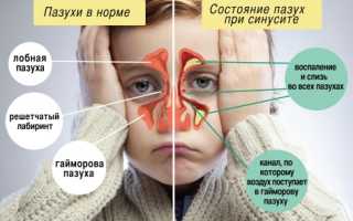 Симптомы и лечение гайморита у детей по Комаровскому