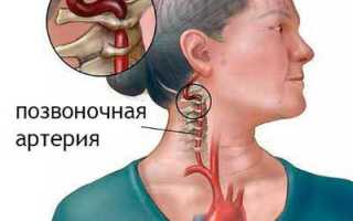 Вертеброгенная цервикалгия – причины, симптомы и лечение болезни