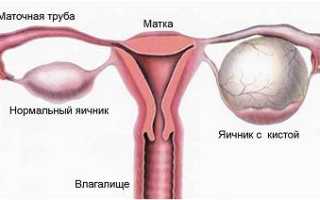 Как определяют кисту яичника