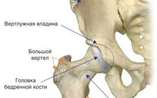 Шейка бедра. Где находится у человека, симптомы перелома, трещины, некроза, вывиха, лечение, операция, реабилитация