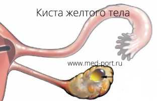 Симптомы и лечение кисты желтого тела