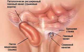 Что делать при обнаружении паховой грыжи?
