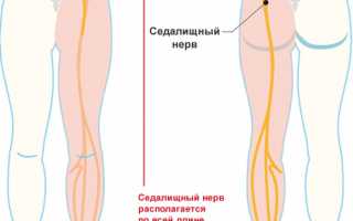 Симптомы и лечение защемления нерва в ноге