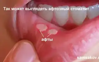 Афтозный Стоматит – Причины и Лечение