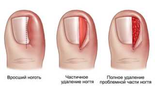 Лазерная хирургия вросшего ногтя: безболезненный способ