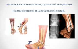 Болит голеностоп при ходьбе