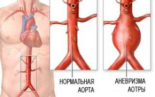 Что такое аневризма аорты брюшной полости?