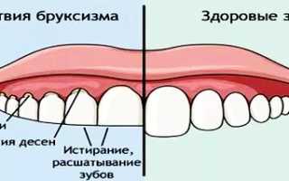 Почему скрипят зубами во сне и как от этого избавиться